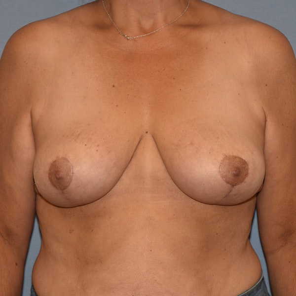 Breast Reduction Before & After Gallery - Patient 173624322 - Image 2