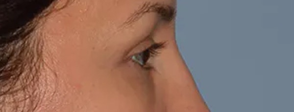 Eyelid Lift Before & After Gallery - Patient 173624323 - Image 6