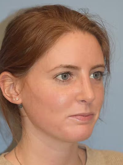 Rhinoplasty Before & After Gallery - Patient 173624330 - Image 4