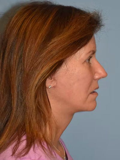 Facelift Before & After Gallery - Patient 173624327 - Image 8