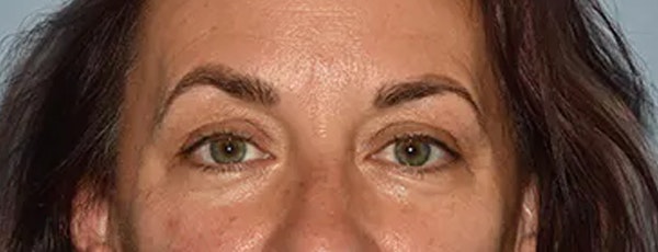 Eyelid Lift Before & After Gallery - Patient 173624335 - Image 1