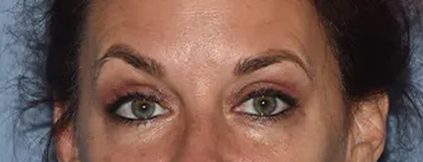 Eyelid Lift Before & After Gallery - Patient 173624335 - Image 2
