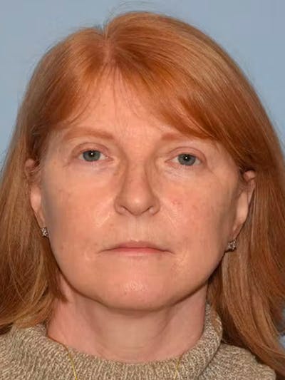 Facelift Before & After Gallery - Patient 173624334 - Image 2