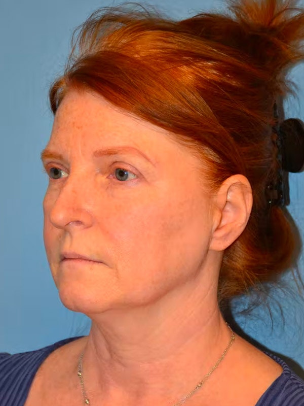 Facelift Before & After Gallery - Patient 173624334 - Image 3