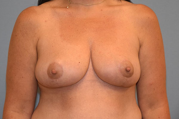 Breast Reduction Before & After Gallery - Patient 173624333 - Image 2