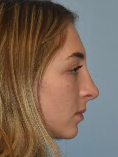 Rhinoplasty Before & After Gallery - Patient 173624336 - Image 2