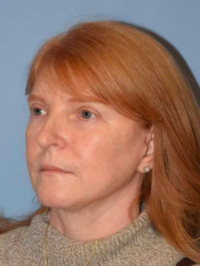 Facelift Before & After Gallery - Patient 173624334 - Image 4