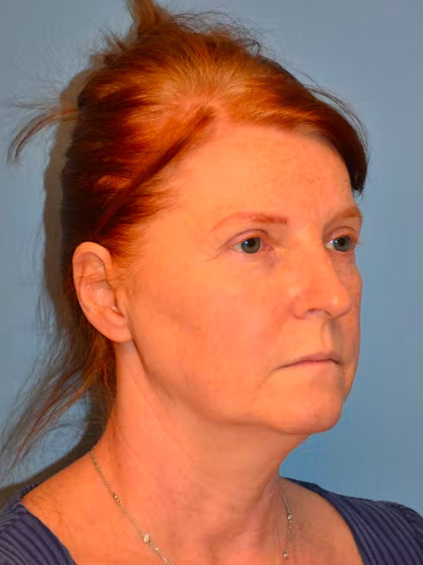 Facelift Before & After Gallery - Patient 173624334 - Image 5