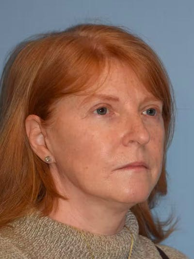 Facelift Before & After Gallery - Patient 173624334 - Image 6