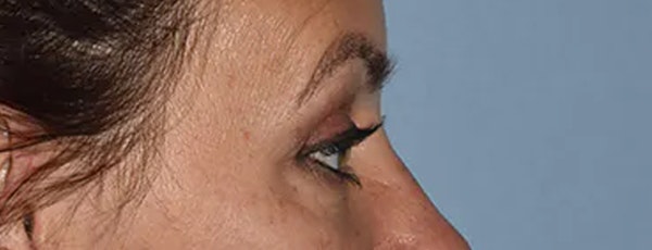 Eyelid Lift Before & After Gallery - Patient 173624335 - Image 10