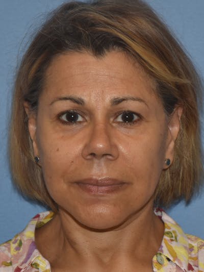 Facelift Before & After Gallery - Patient 173624339 - Image 2