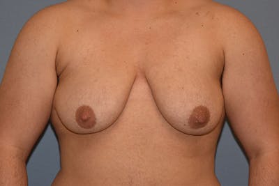 Gynecomastia Before & After Gallery - Patient 173624340 - Image 1