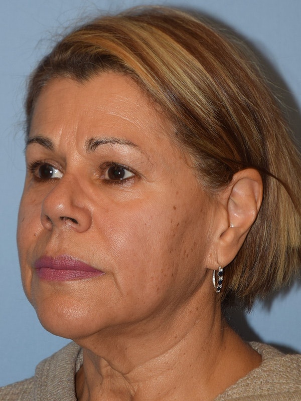 Facelift Before & After Gallery - Patient 173624339 - Image 3