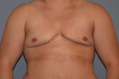 Gynecomastia Before & After Gallery - Patient 173624340 - Image 2