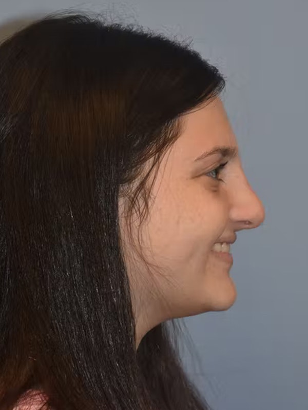 Rhinoplasty Before & After Gallery - Patient 173624342 - Image 2