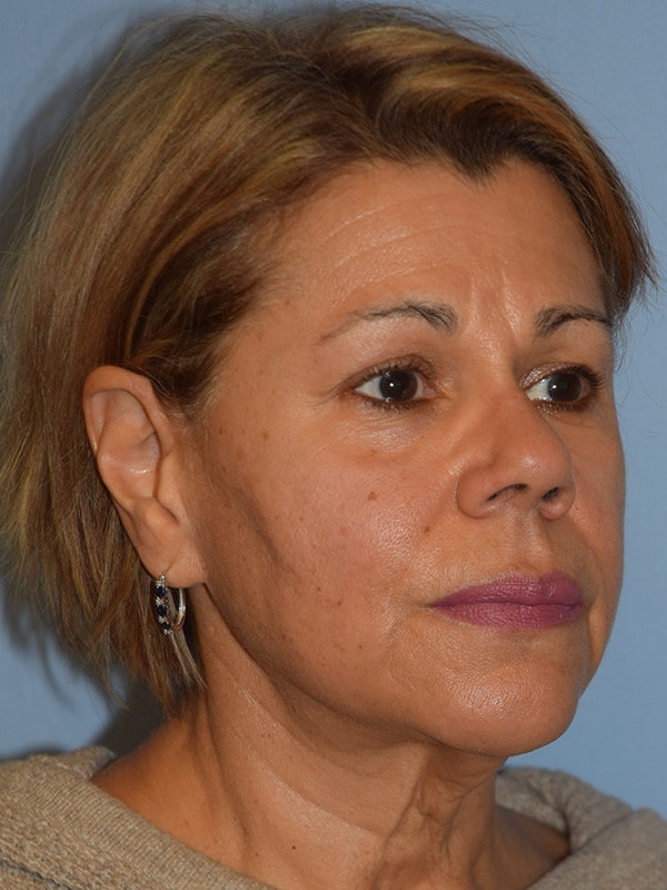 Facelift Before & After Gallery - Patient 173624339 - Image 5