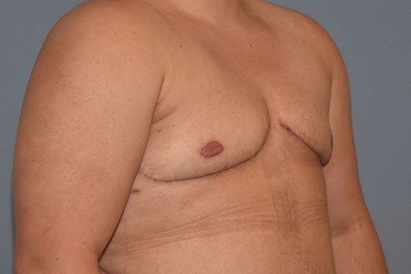 Gynecomastia Before & After Gallery - Patient 173624340 - Image 4
