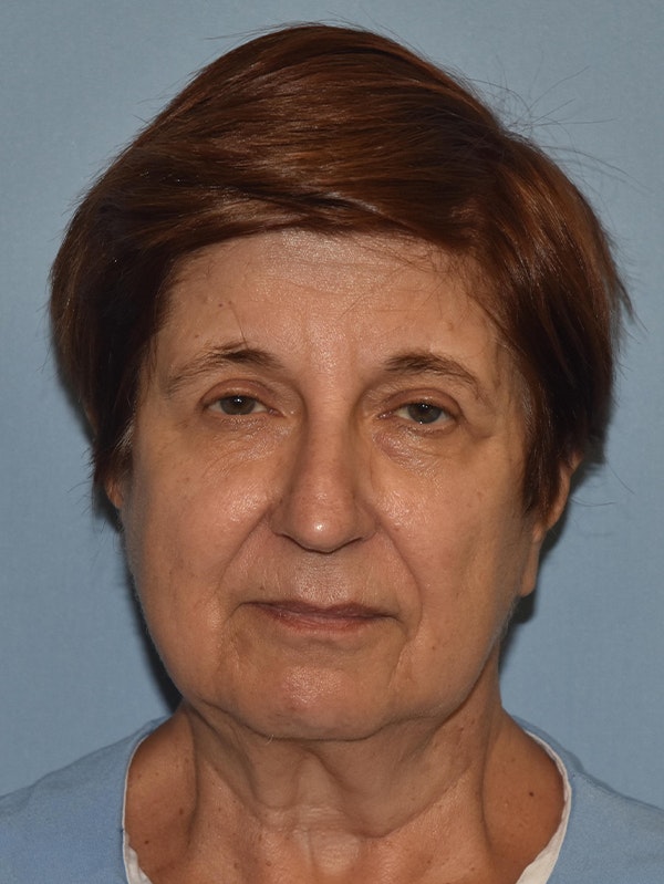 Facelift Before & After Gallery - Patient 173624367 - Image 1