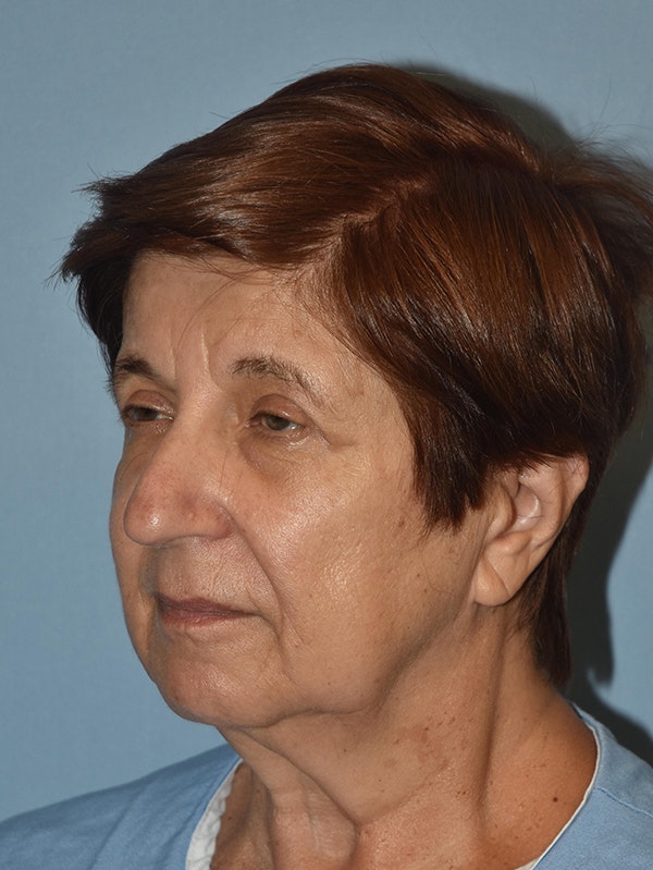 Facelift Before & After Gallery - Patient 173624367 - Image 3
