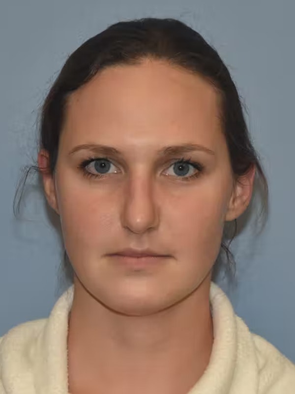Rhinoplasty Before & After Gallery - Patient 173624362 - Image 4