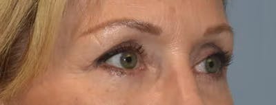 Eyelid Lift Before & After Gallery - Patient 173624364 - Image 4