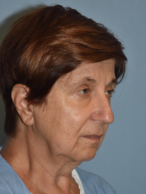 Facelift Before & After Gallery - Patient 173624367 - Image 7