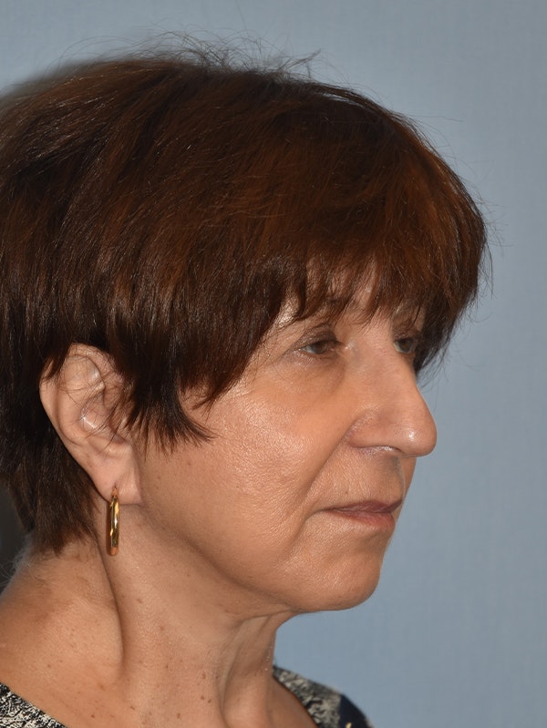 Facelift Before & After Gallery - Patient 173624367 - Image 8