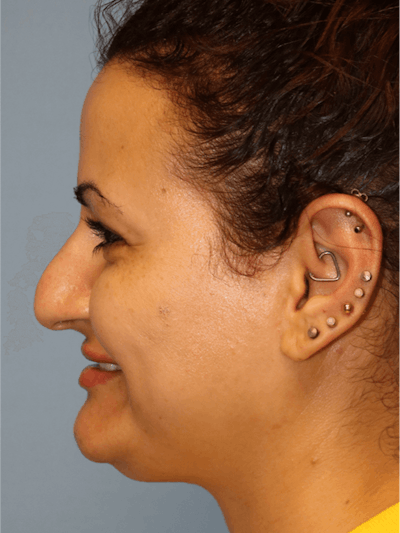 Rhinoplasty Before & After Gallery - Patient 173624369 - Image 1
