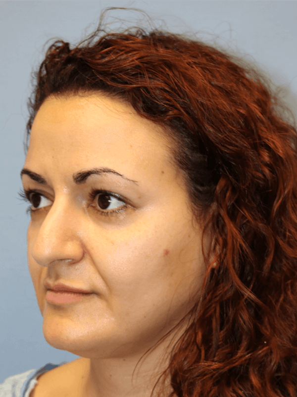 Rhinoplasty Before & After Gallery - Patient 173624369 - Image 3