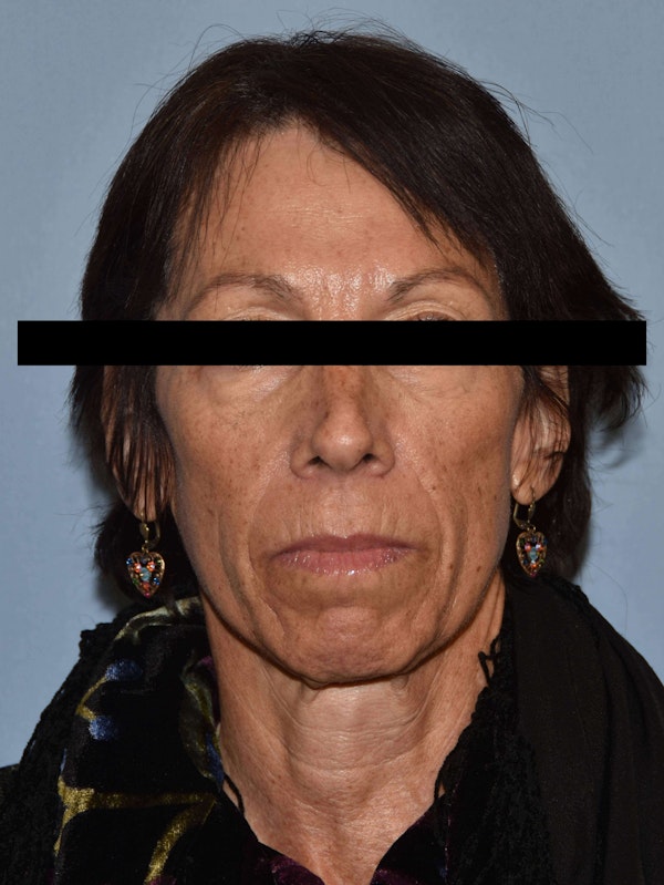Facelift Before & After Gallery - Patient 173624372 - Image 1
