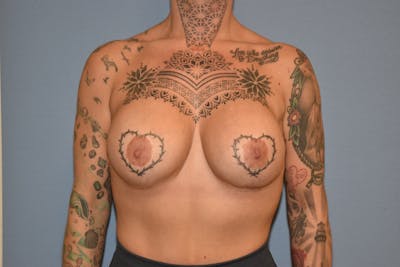 Breast Augmentation Before & After Gallery - Patient 173624743 - Image 2