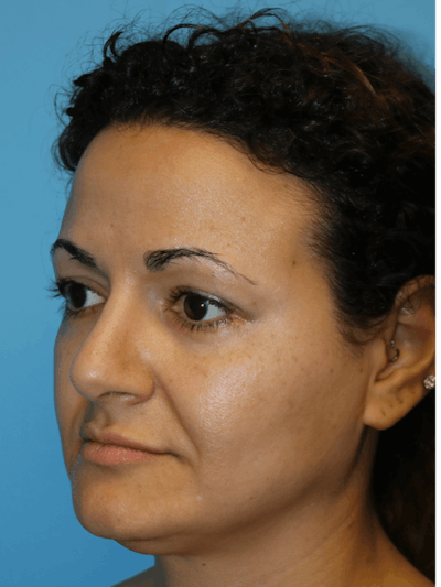 Rhinoplasty Before & After Gallery - Patient 173624369 - Image 4