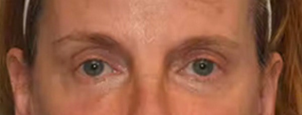 Eyelid Lift Before & After Gallery - Patient 173624371 - Image 2