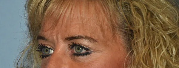 Eyelid Lift Before & After Gallery - Patient 173624762 - Image 4