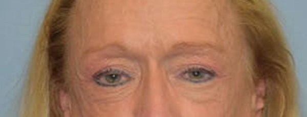 Eyelid Lift Before & After Gallery - Patient 173624913 - Image 1