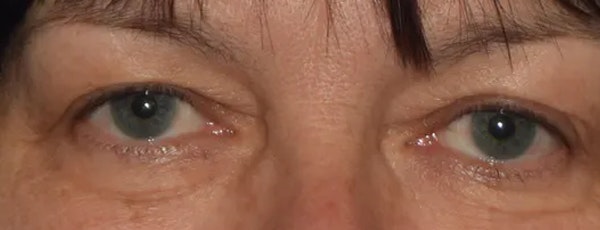 Eyelid Lift Before & After Gallery - Patient 173624926 - Image 1