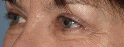 Eyelid Lift Before & After Gallery - Patient 173624926 - Image 4