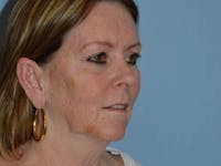 Facelift Before & After Gallery - Patient 173624937 - Image 1