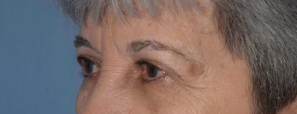 Eyelid Lift Before & After Gallery - Patient 173624936 - Image 2
