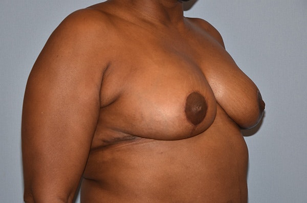 Breast Reduction Before & After Gallery - Patient 173987014 - Image 4