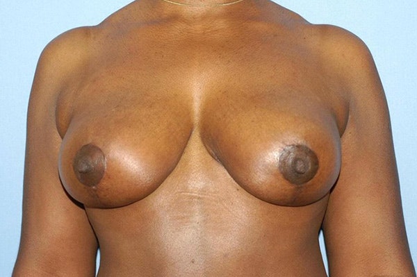 Breast Reduction Before & After Gallery - Patient 173987281 - Image 2