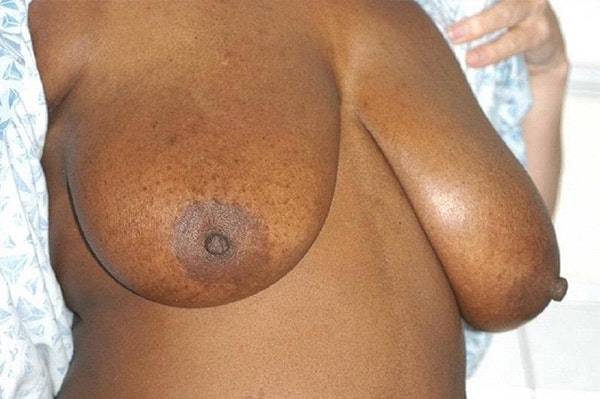 Breast Reduction Before & After Gallery - Patient 173987281 - Image 3