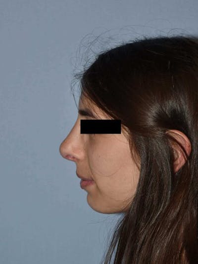 Rhinoplasty Before & After Gallery - Patient 173989073 - Image 2