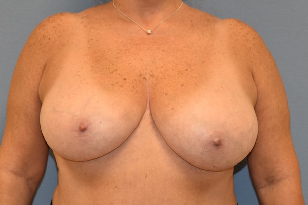Breast Reduction Before & After Gallery - Patient 173989439 - Image 1