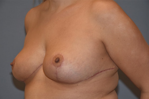 Breast Reduction Before & After Gallery - Patient 173989742 - Image 6