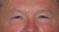 Eyelid Lift Before & After Gallery - Patient 177445039 - Image 1