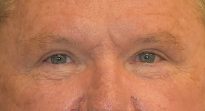 Eyelid Lift Before & After Gallery - Patient 177445039 - Image 2