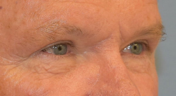 Eyelid Lift Before & After Gallery - Patient 177445039 - Image 4