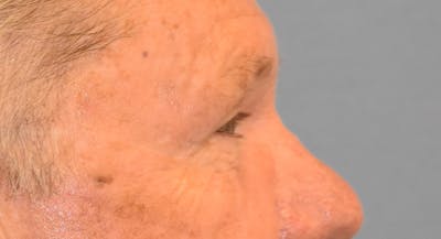 Eyelid Lift Before & After Gallery - Patient 177445039 - Image 6