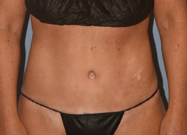 Tummy Tuck Before & After Gallery - Patient 178926811 - Image 2